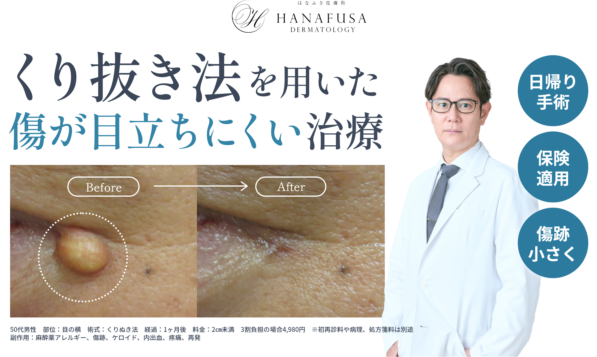 くり抜き法を用いた傷が目立ちにくい治療
