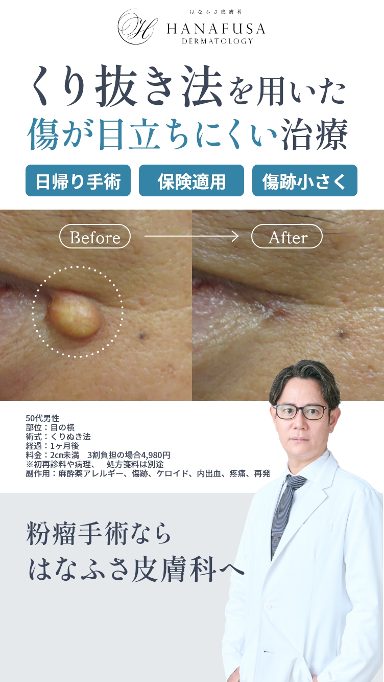 くり抜き法を用いた傷が目立ちにくい治療